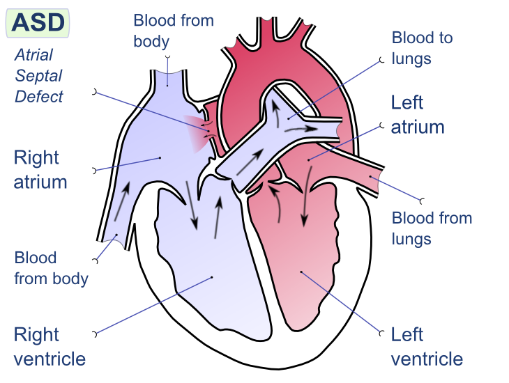 Labelled diagram of a heart with Atrial Septal Defect (ASD)