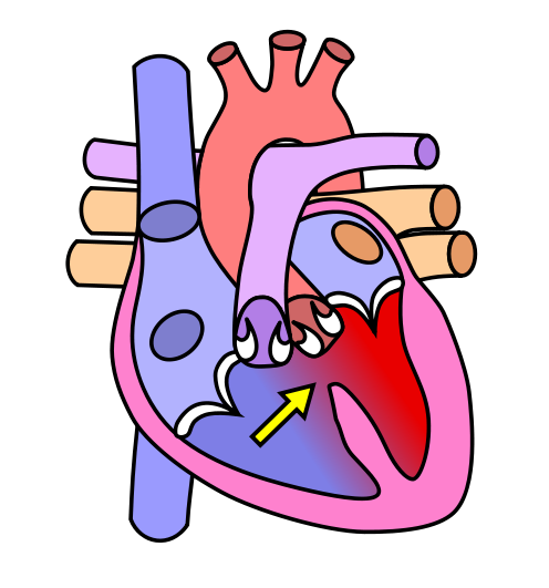 Image of a heart with Ventricular Septal Defect (VSD). It shows the mixing of oxygenated and de-oxygenated blood between the ventricles